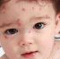 Памятка для родителей «Профилактика кори» - Усманская МРБ